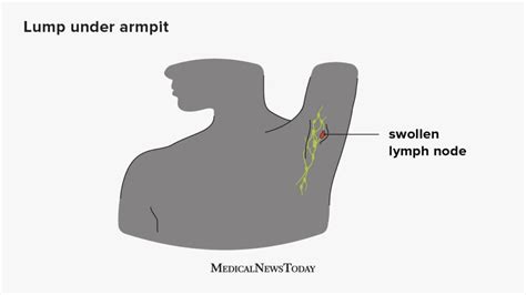 photos of armpit lumps|check armpit lymph nodes.